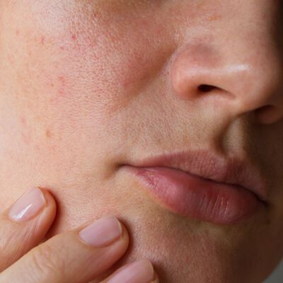 Rosto de mulher mostrando sintomas de rosácea, incluindo vermelhidão, inflamação e vasos sanguíneos visíveis (telangiectasias) nas bochechas e nariz