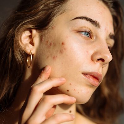 Close-up do rosto de uma pessoa com acne.