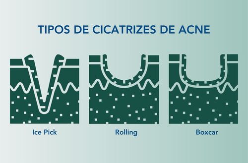 Representa&ccedil;&atilde;o visual de cicatrizes ice pick, rolling e boxcar.