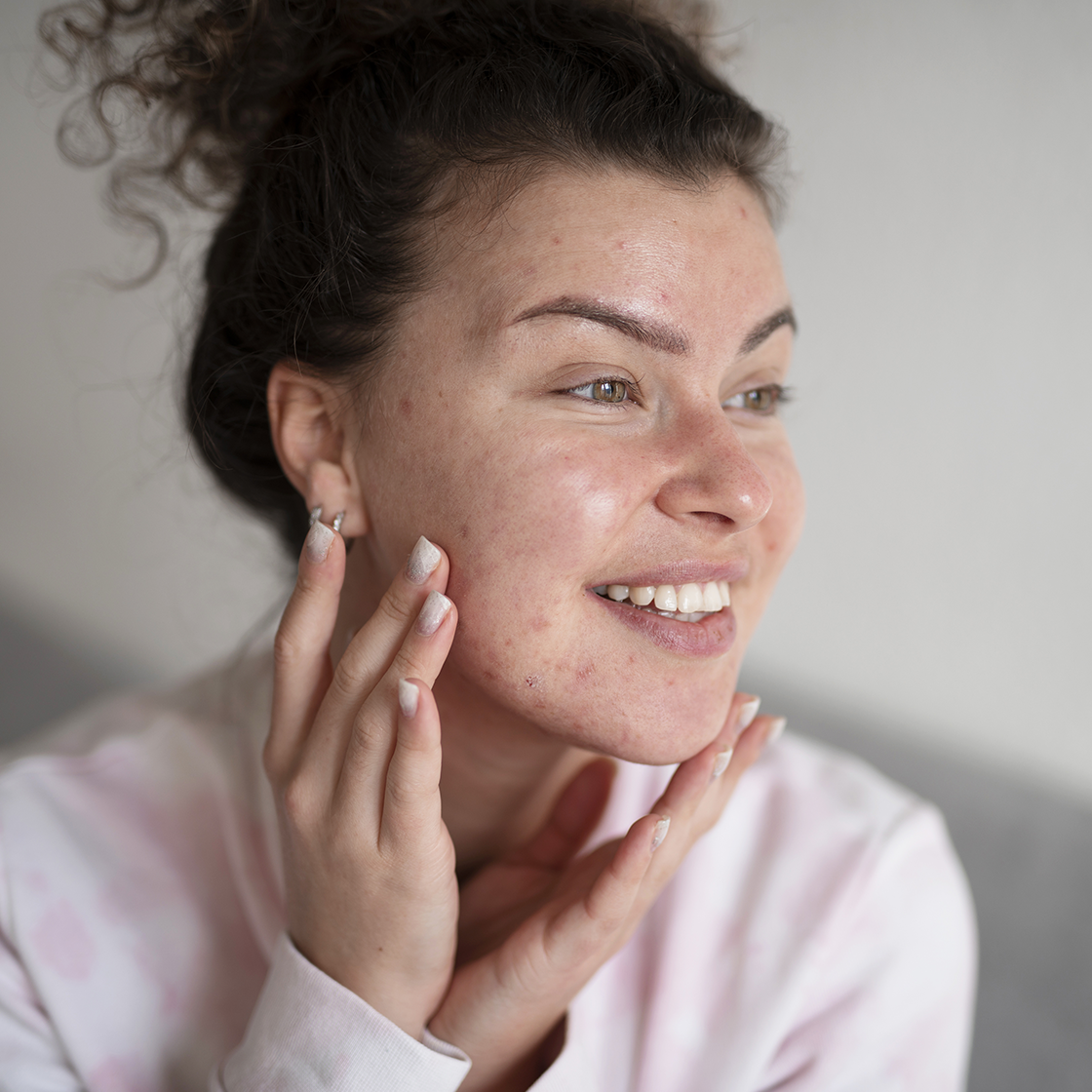Cicatriz de acne: causas, como tirar ou melhorar